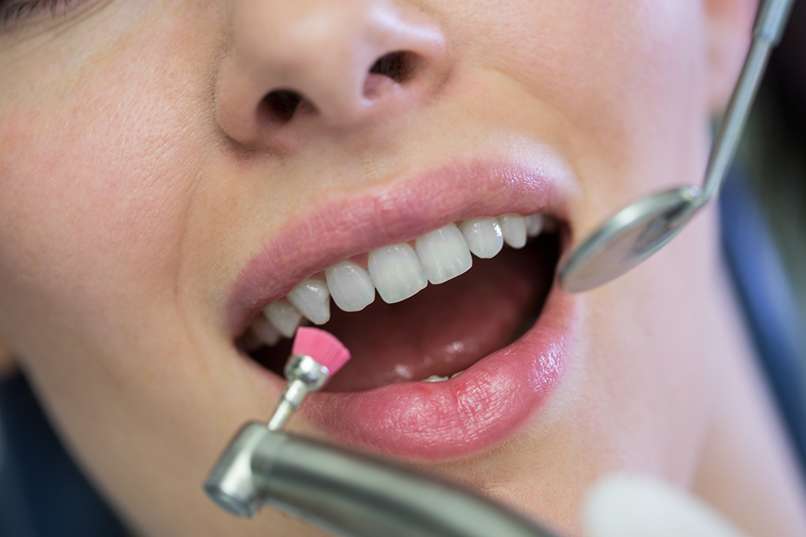 Teeth Polishing