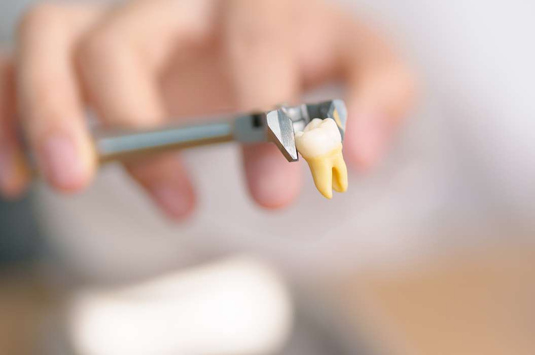 Impacted Tooth Extraction