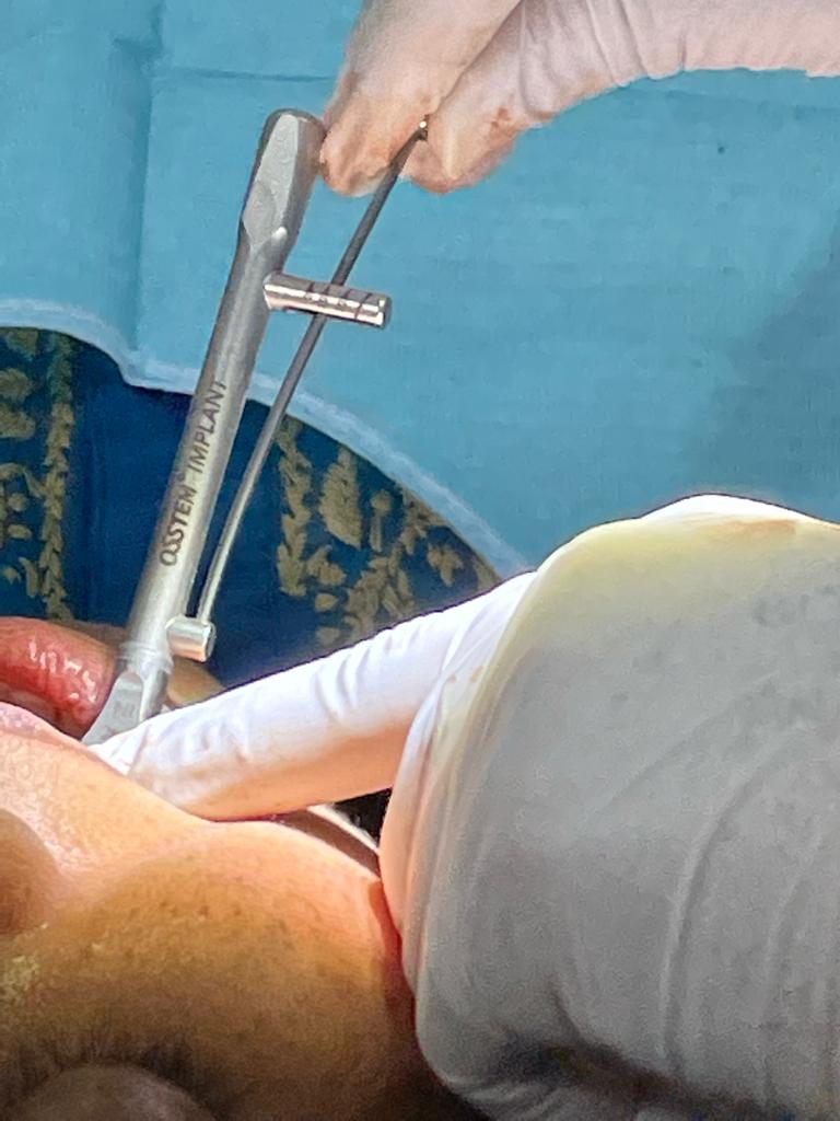 Dental implant surgery close-up using osteem tool at Sharanya Dental Clinic Kondapur