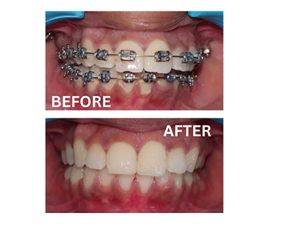 Before and after image of teeth alignment using metal braces at Sharanya Dental Clinic, Kondapur, Hyderabad.