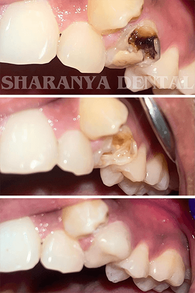 Before and after images of tooth decay treatment and restoration at Sharanya Dental Clinic, Kondapur