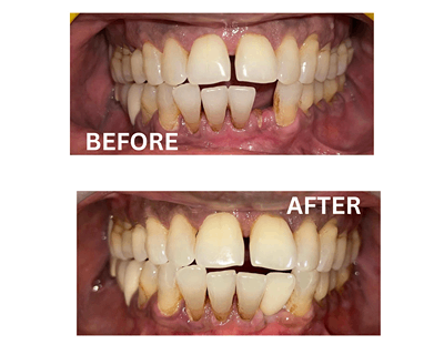 Before and after image showing gap closure and cleaning with conservative treatment at Sharanya Dental Clinic, Kondapur.