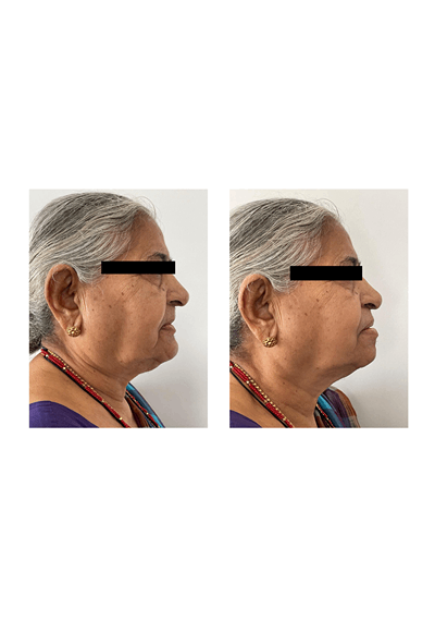 Before and after denture placement showing improved facial profile in an elderly patient at Sharanya Dental Clinic, Kondapur.
