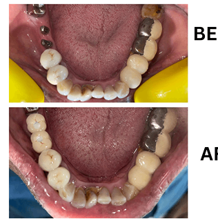 Before and after lower jaw dental implants placed at Sharanya Dental Clinic, showing restored chewing function and aesthetics.