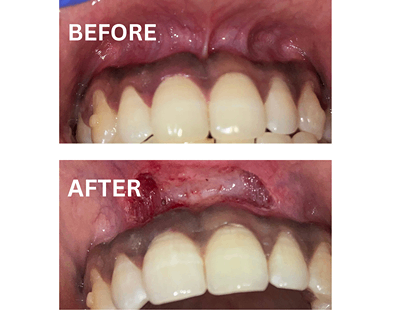 Before and after laser gum treatment at Sharanya Dental showing precise and bloodless flap surgery for cosmetic correction.