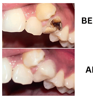 Before and after image of tooth decay restoration using composite fillings at Sharanya Dental Clinic, Kondapur.