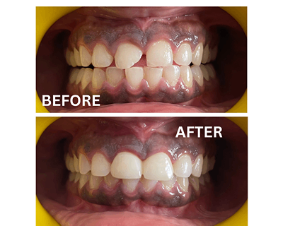 Before and after results of root canal treatment performed at Sharanya Dental Clinic in Kondapur, Hyderabad.