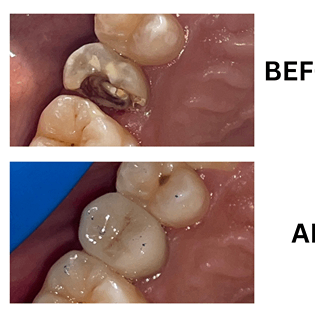Before and after root canal treatment showing complete restoration of a decayed molar at Sharanya Dental Clinic, Kondapur.