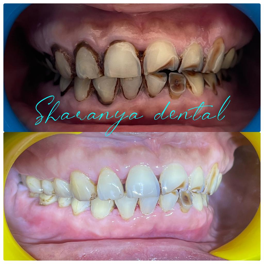 Before and after image of dental scaling and plaque removal at Sharanya Dental Clinic, Kondapur, Hyderabad