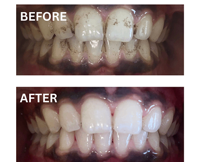 Before and after dental scaling and polishing at Sharanya Dental Clinic showing removal of plaque and stains.
