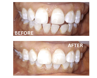 Before and after smile design treatment at Sharanya Dental Clinic showing improved symmetry and aesthetics.