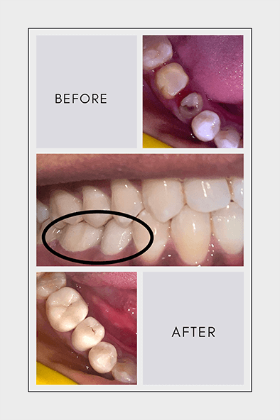 Before and after image showing tooth alignment improvement through orthodontic treatment at Sharanya Dental Clinic in Kondapur, Hyderabad.