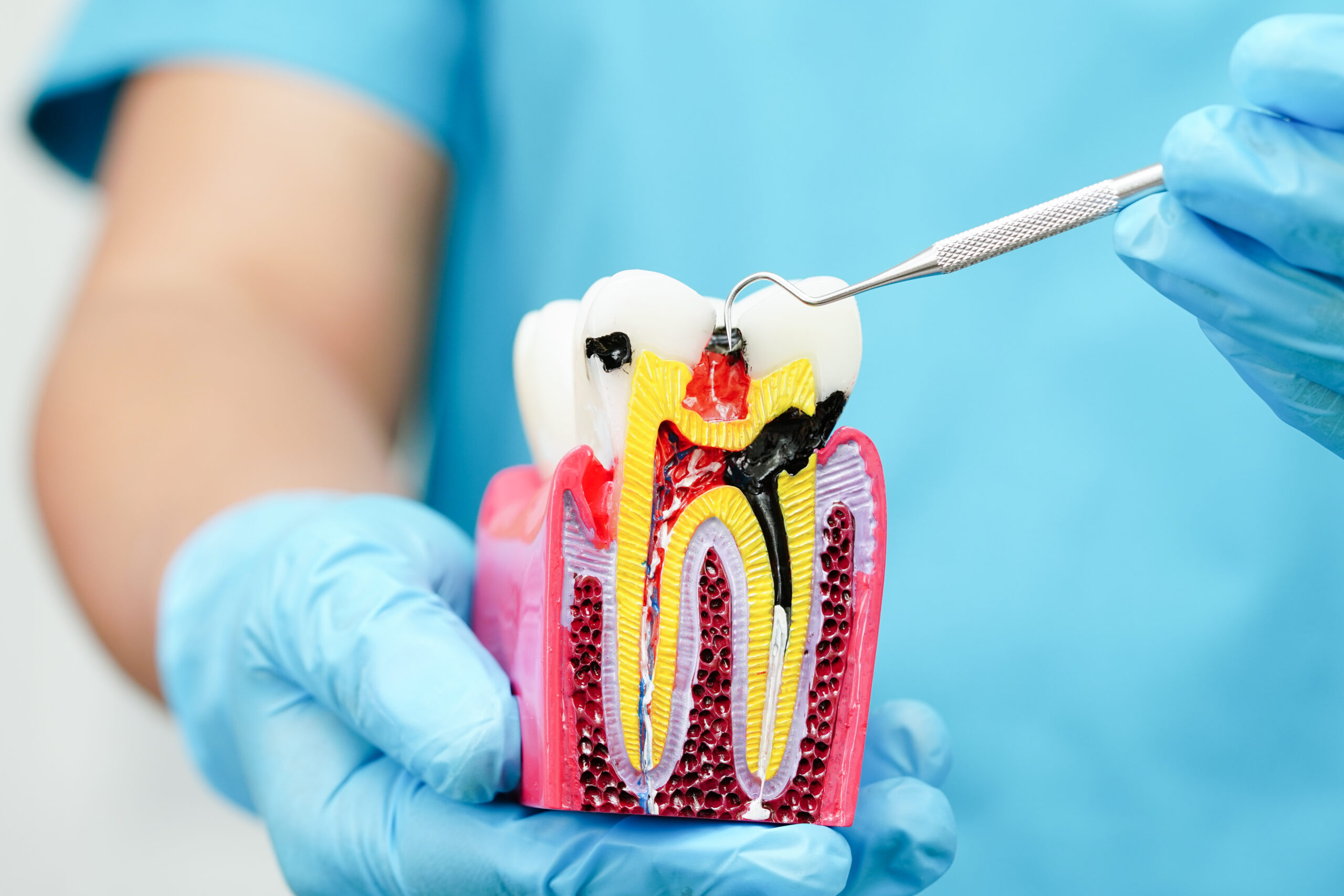 Top 10 Reasons You Shouldn’t Delay a Root Canal Treatment